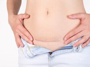 císařský řez císařský řez